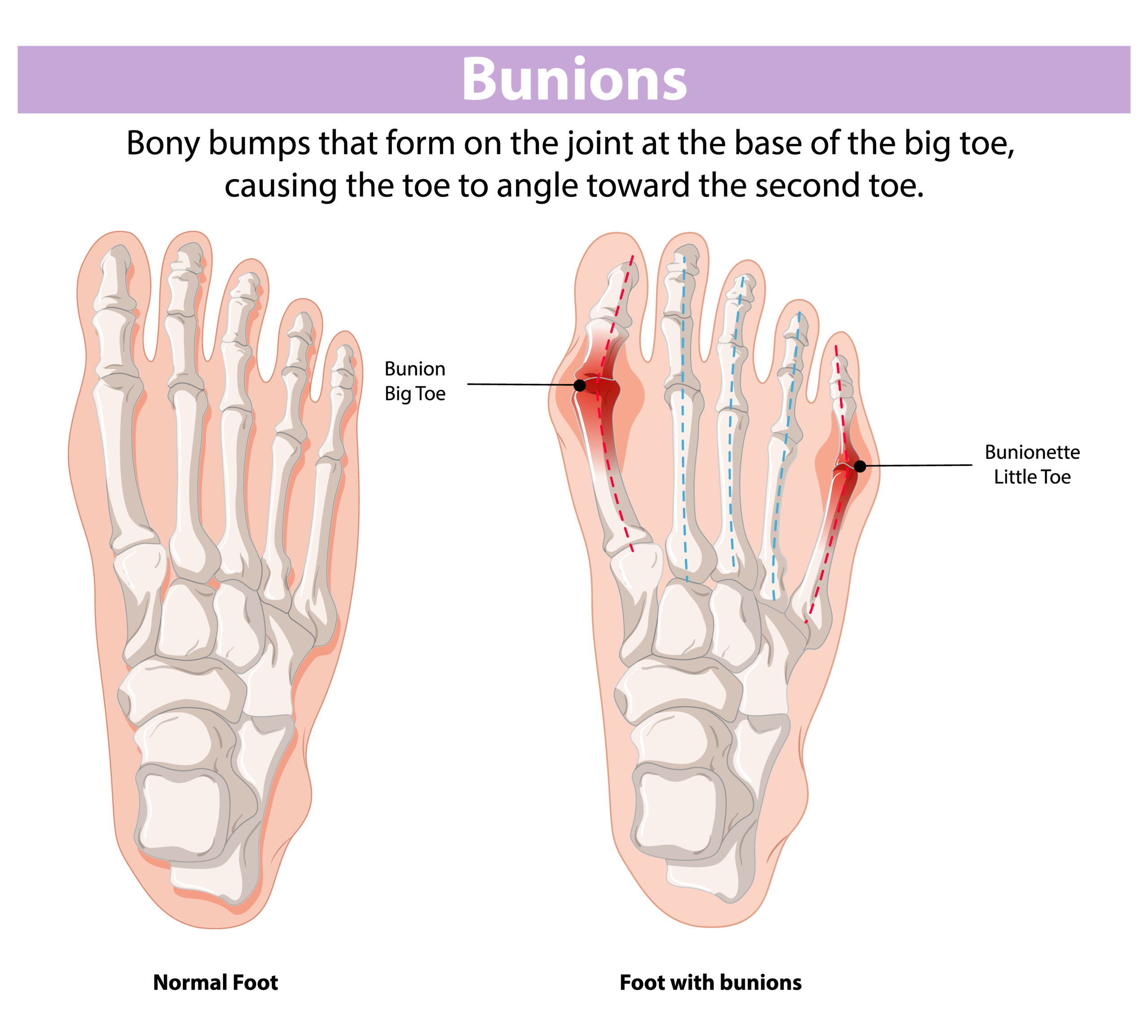 WHAT-IS-BURSITIS
